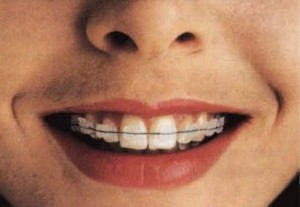https://www.art1a1d.com/wp-content/uploads/2017/08/invisible-braces.jpg